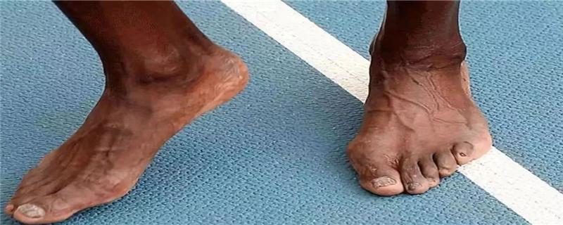 如何避免跑步脚指甲瘀 跑步跑得脚指甲淤青 如何处理