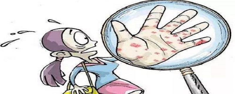 带状疱疹艾灸哪些部位（带状疱疹艾灸哪里）-九图集