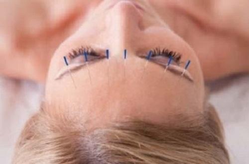 针灸对面瘫有用吗 面瘫直接针灸好吗-九图集