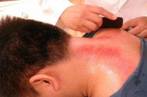 刮痧可以降血压吗 刮痧可以降血压吗百度百科