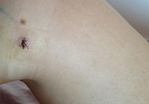 吸脂手术有什么危害 腰部吸脂手术有什么危害-九图集