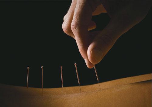 针灸可以治疗哪些病（针灸可以治疗哪些病,针是什么针）-九图集