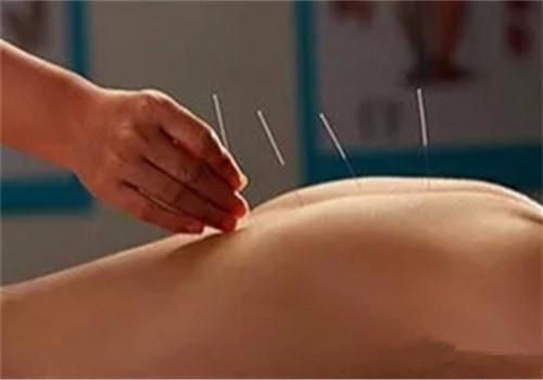 针灸减肥效果好吗 肚子针灸减肥效果好吗-九图集