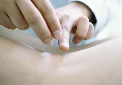 月经期可以针灸吗(月经期可以针灸治疗颈椎病吗)