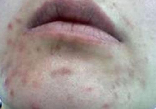 长胡子的地方长痘痘是怎么回事（长胡子的地方长痘痘是什么原因）-九图集