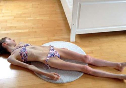 得了厌食症如何治疗(得了厌食症怎么治疗)