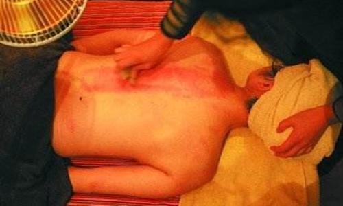 刮痧后容易出汗正常吗（刮痧后易出汗为什么）