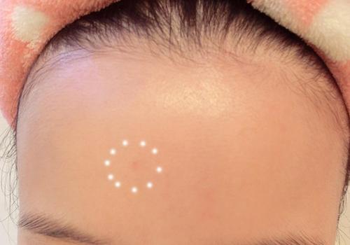 怀孕期间额头长痘是什么原因 怀孕期间额头长痘是什么原因引起的-九图集