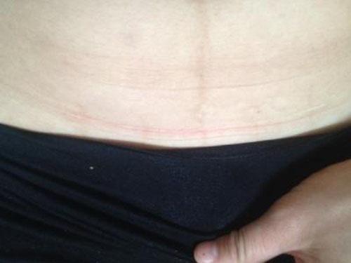 剖腹产的危害(甲减孕妇剖腹产的危害)-九图集